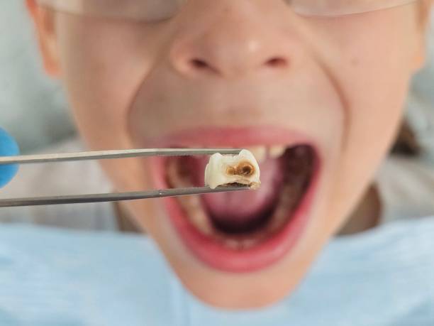Best Emergency Treatment for Dental Infections or Abscesses in Dublin, PA